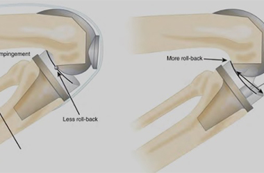 posterior Publication by Dr Tarabichi