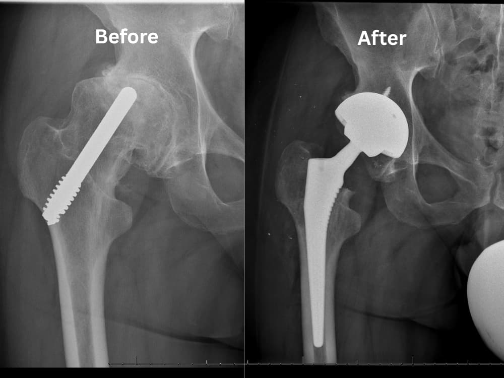 Xray of pre and post hip replacement surgery