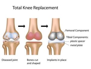 Knee-Replacement-Surgery-Dubai