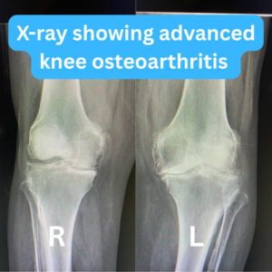 Xray showing advanced knee osteoarthritis